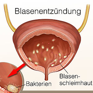 Kraichgau Fanfarenzug Blasenentzündung